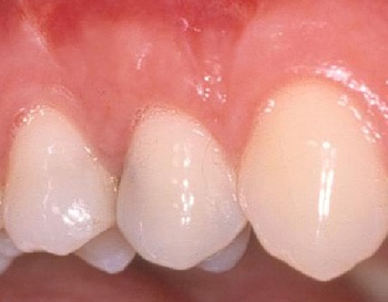 Κάλυψη της υποχώρησης ούλου με μόσχευμα ούλου